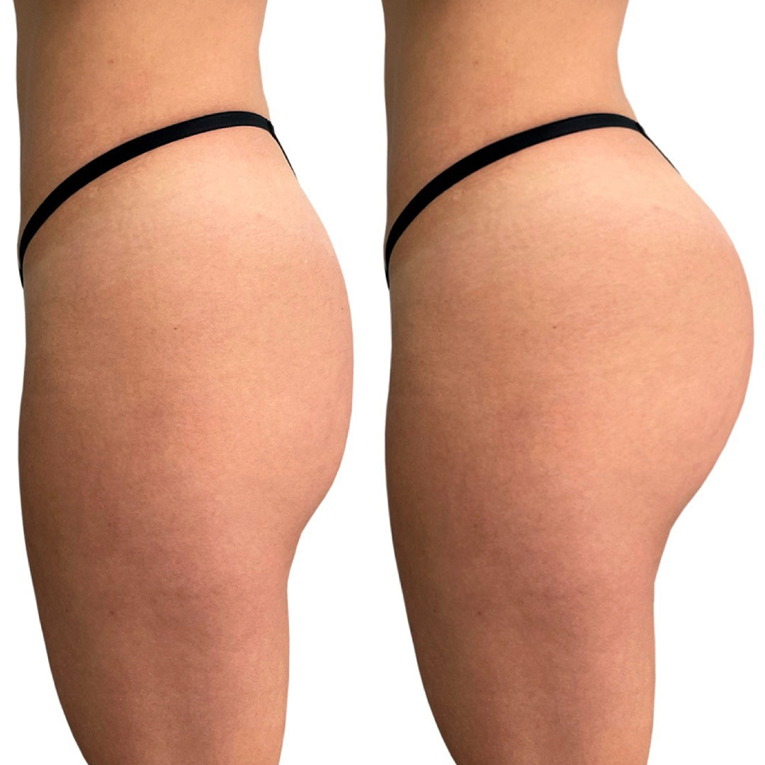 AUMENTO DE GLUTEOS ACIDO HIALURONICO