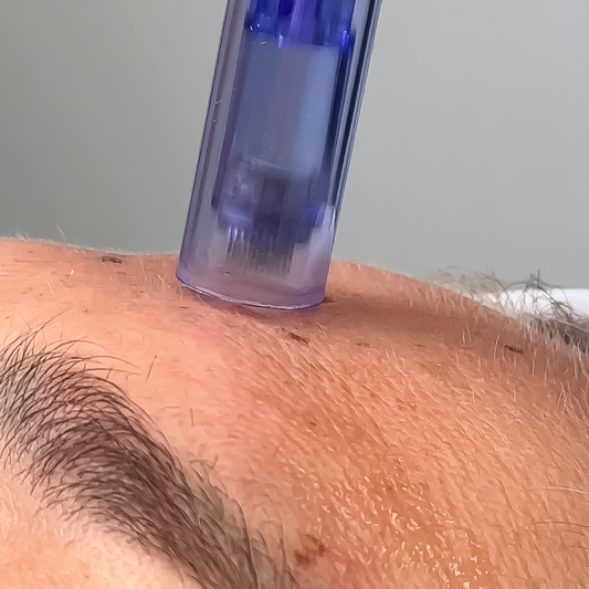PLASMA RICO EN PLAQUETA CON DERMAPEN