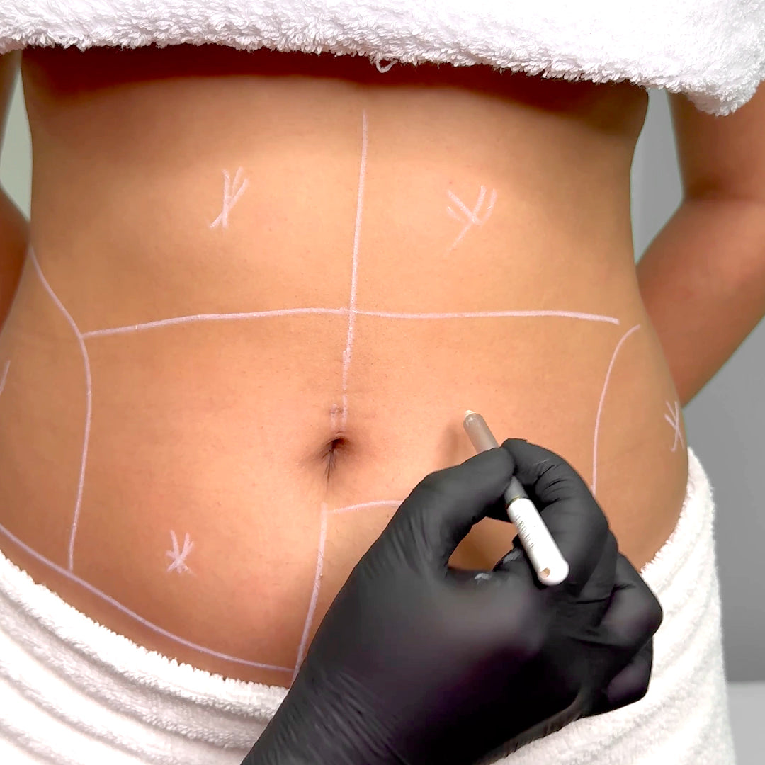 HIDROLIPOCLASIA